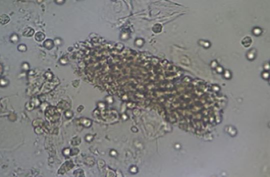elementos-do-sedimento-urinario-hemacias-leucocitos-cristais-cilindros
