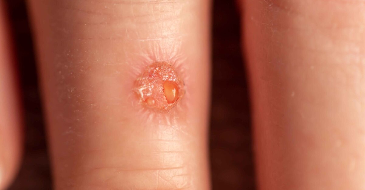 trransudato-vs-exsudato-diferencas-criterios-de-light-derrame-pleural-biomedicina