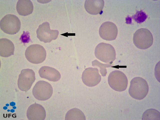 alteracoes-morfologicas-das-hemacias-biomedicina-esquizocitos