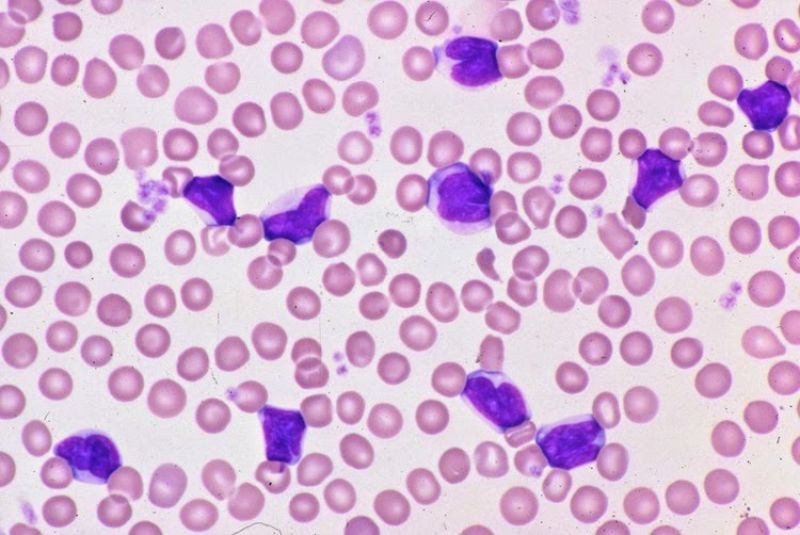 linfocitos-reativos-vs-neoplasicos-principais-diferencas-morfologicas